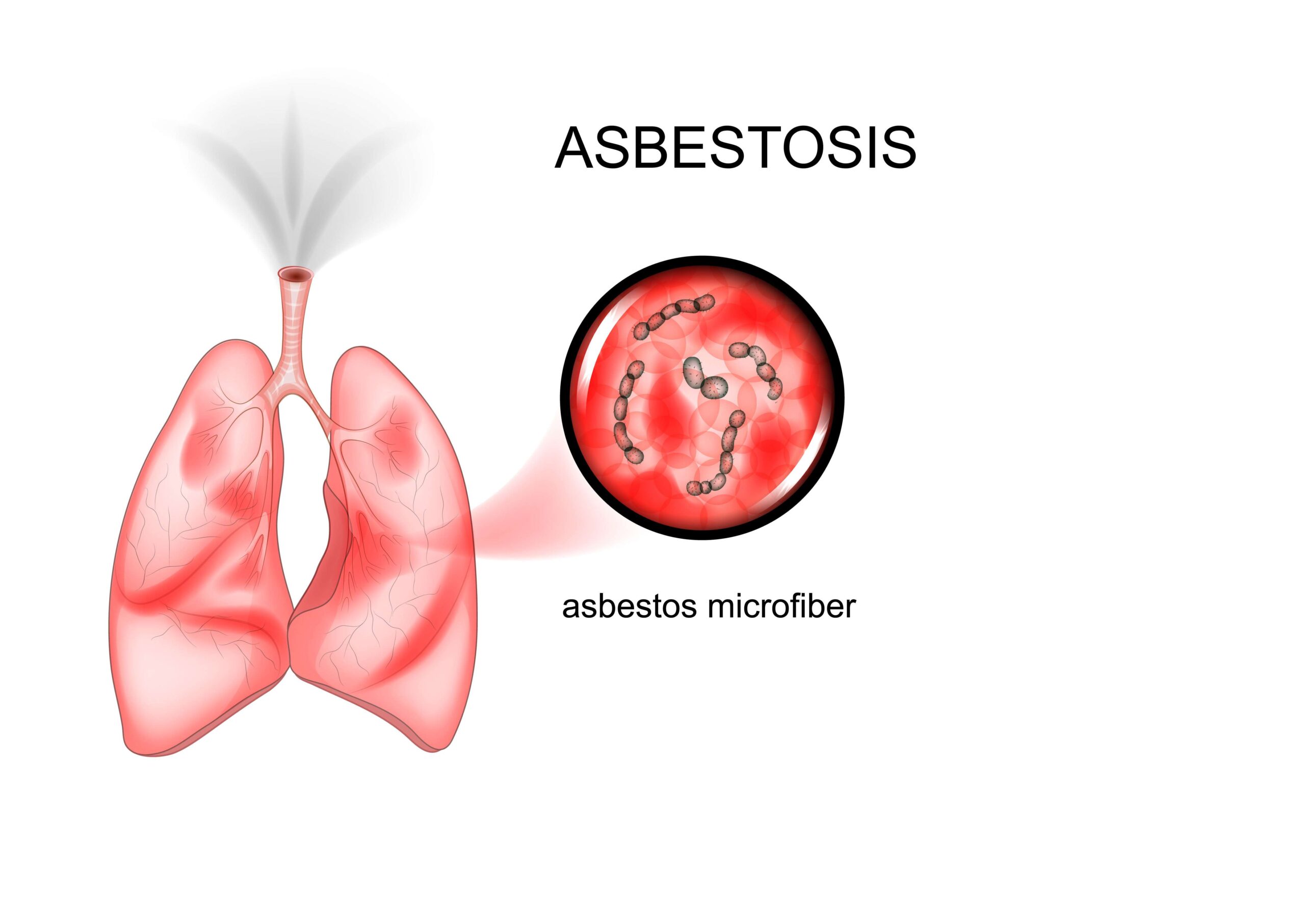 Asbestos Hero